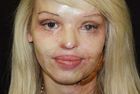 Katie Piper walczy o dawną twarz