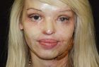 Katie Piper walczy o dawną twarz