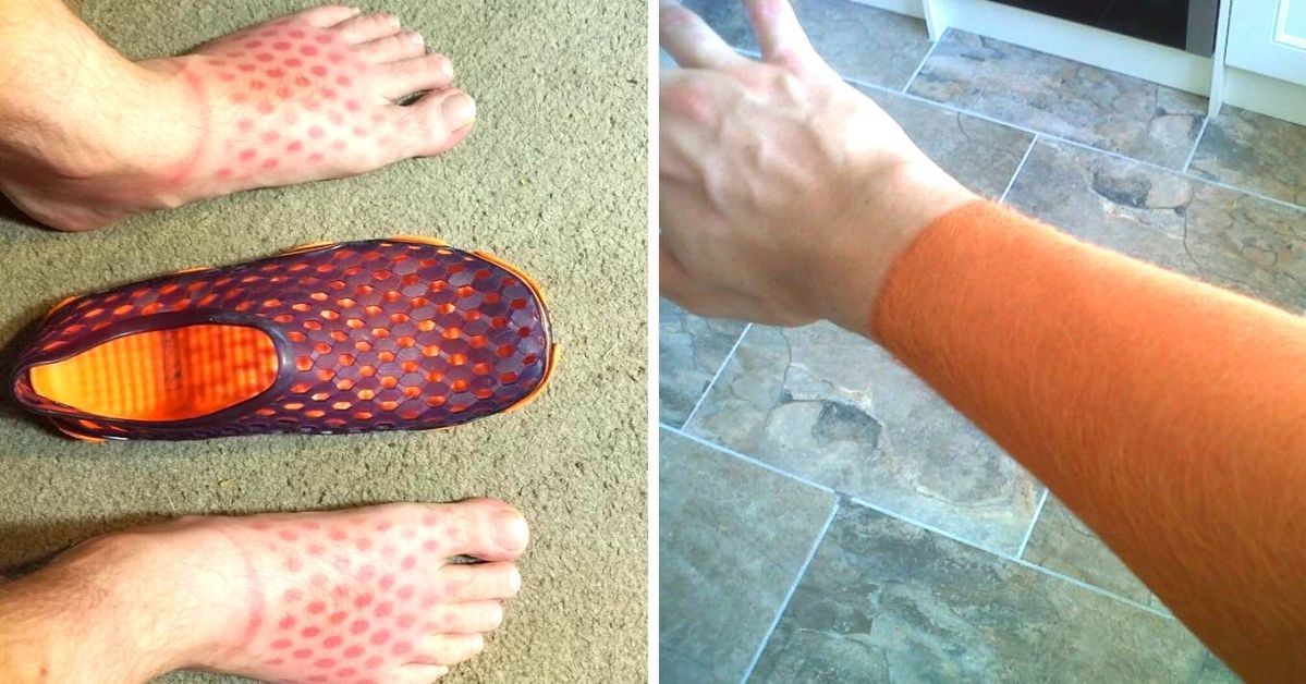 19 People Who Have Not Managed to Get a Proper Tan. Their Photos May Serve as a Warning to Others