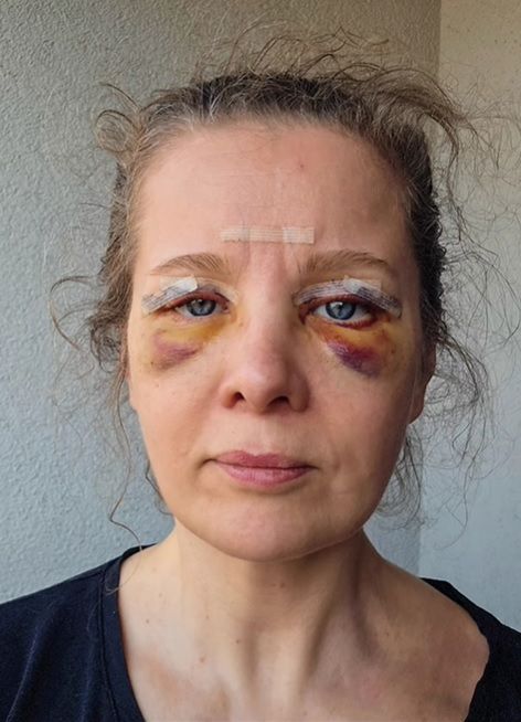 Anna Powierza wycięła sobie nadmiar powiek