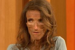 "Rozmowy w toku": najchudsza kobieta świata gościem Ewy Drzyzgi. Waży 25 kilogramów!