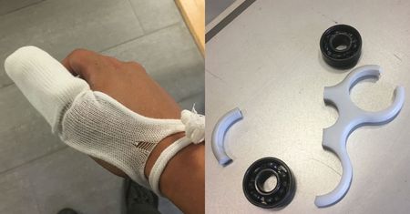 Fidget spinner eksplodował mu w dłoni