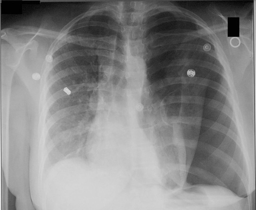 Odma płucna na zdjęciu RTG