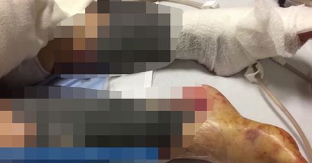 Kochała owoce morza. Bakterie zjadły ją od środka