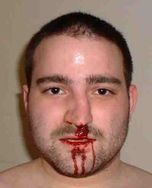 Krwotok z nosa