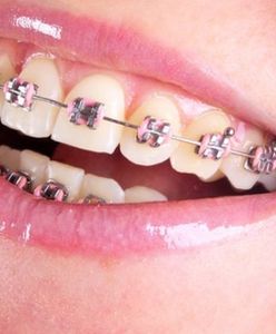Niewłaściwie stosowane aparaty na zęby mogą być śmiertelnie niebezpieczne