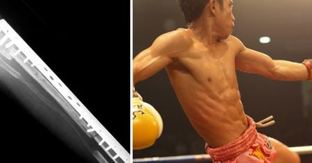 Tak teraz wygląda doping w sporcie - wszczepił sobie implant