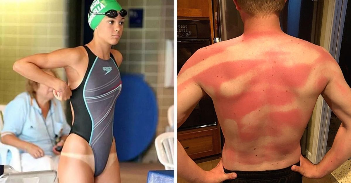 19 People Who Weren’t Careful While Tanning. The Sun Doesn’t Accept Mistakes