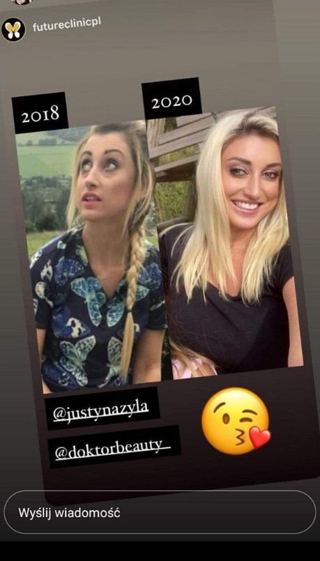 Justyna Żyła przed i po zabiegach medycycny estetycznej