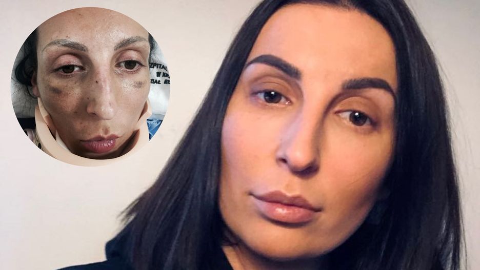 Kobieta nadal jest rehabilitowana