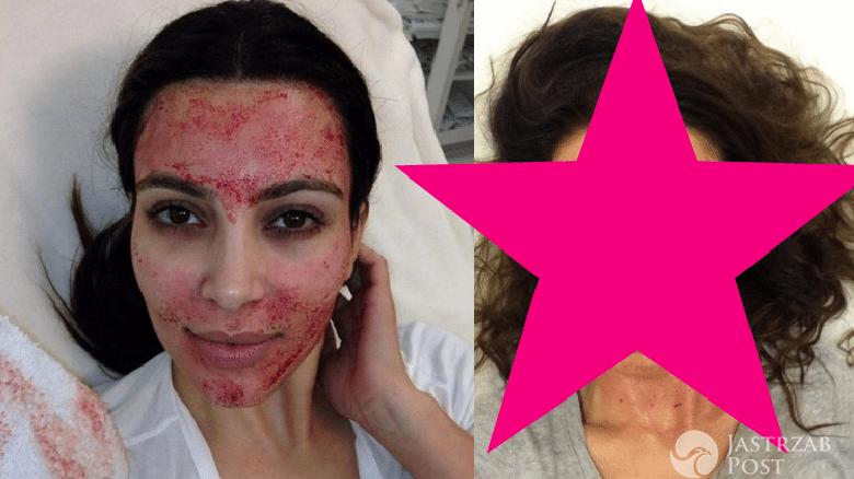 Agnieszka Włodarczyk zastosowała ulubiony zabieg Kim Kardashian