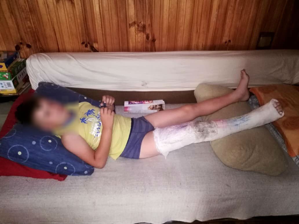 Wojtek ma złamaną kość piszczelową