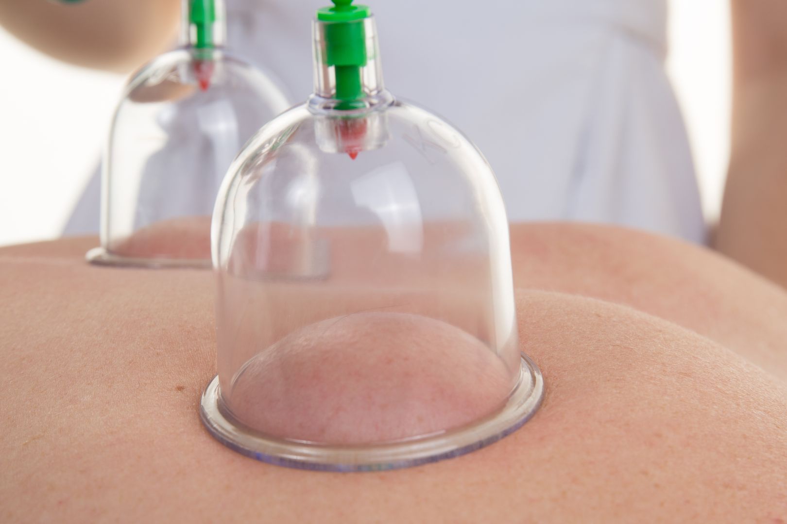 Closeup of therapist placing cup on the back female patient 