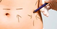 Liposukcja &ndash; czy jest groźna?