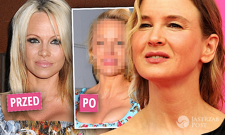 Co się stało z twarzą Pameli Anderson? Zdecydowanie przesadziła z botoksem! Wygląda jak siostra Renee Zellweger