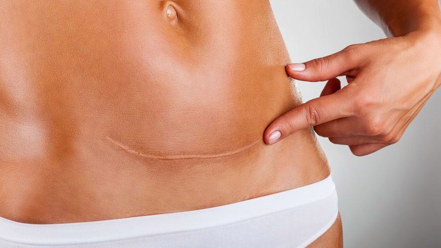 Według statystyk blizny posiada prawie 30 proc. Polaków.