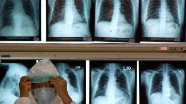 Zdjęcia rentgenowskie chorych na SARS