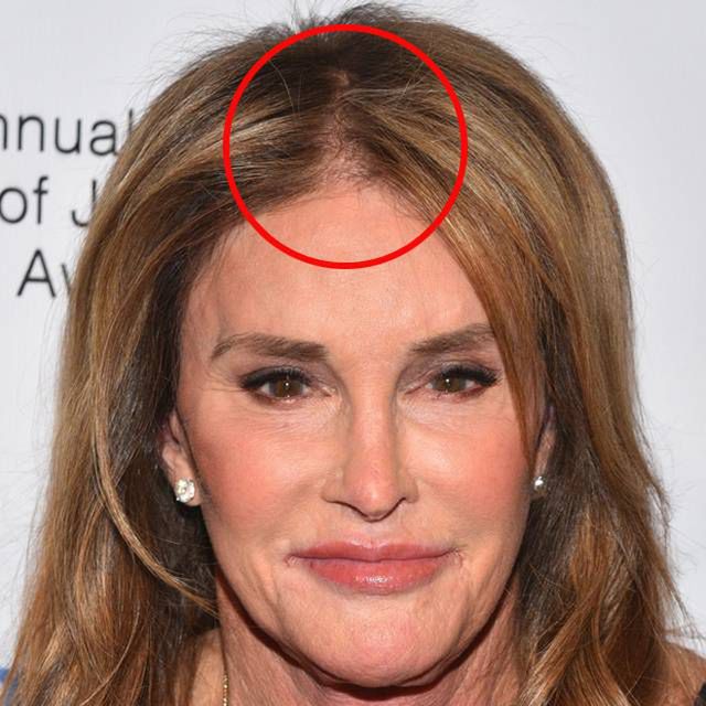 Caitlyn Jenner łysieje