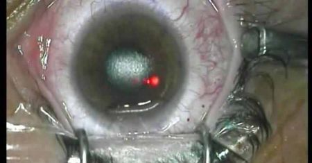 Zabieg metodą LASIK