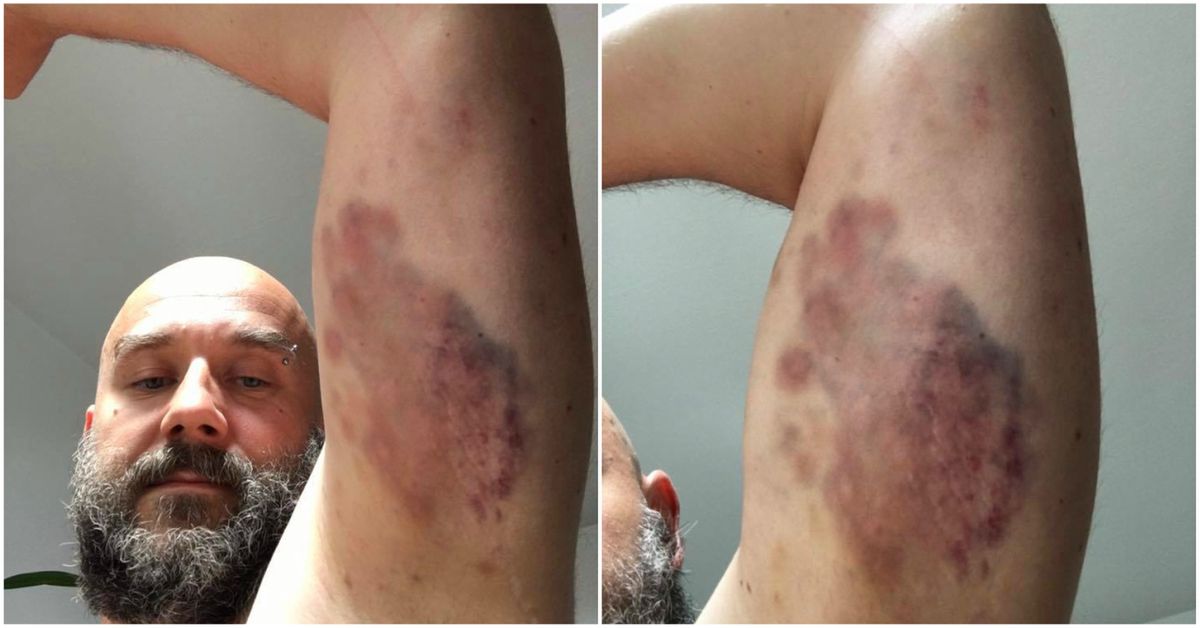 "Oto efekt konfrontacji ze Strażą Marszałkowską". Protestujący z Sejmu publikują zdjęcia swoich ran
