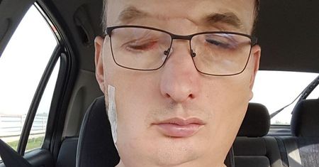 Pierwszy Polak z przeszczepioną twarzą. "Żyję, ale co to za życie?"