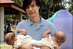 Lekarze rozdzielili bliźniaczki zrośnięte kręgosłupem