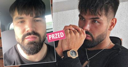 Oszpecony przez zabiegi medycyny estetycznej Paweł Tyburski z "Love Island" pokazał nową twarz. Tak teraz wygląda