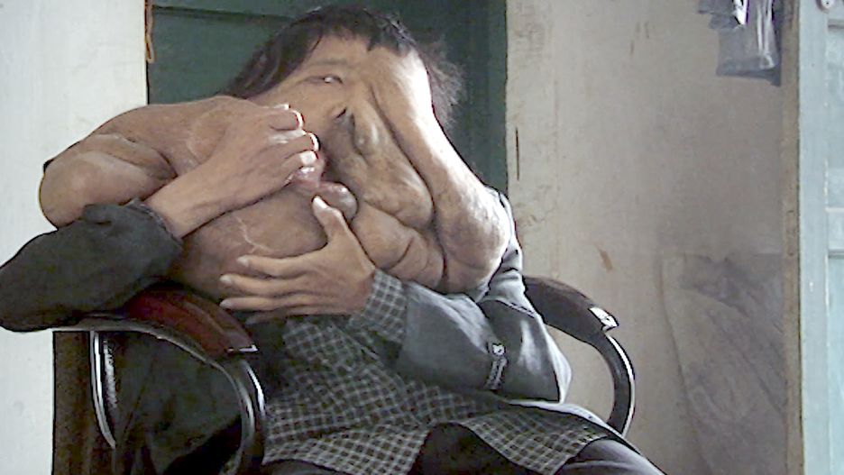 Huang Chuncai to współczesny "chiński człowiek słoń"