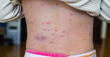 Olsztyn: 6-latka nie była zaszczepiona na ospę. Dziewczynka nie żyje