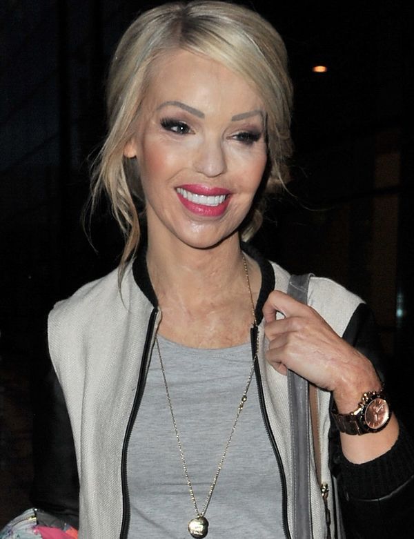 Katie Piper: ofiara ataku kwasem spodziewa się dziecka!