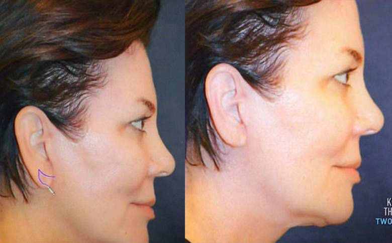 Kris Jenner zmniejszyła sobie uszy (przed i po)