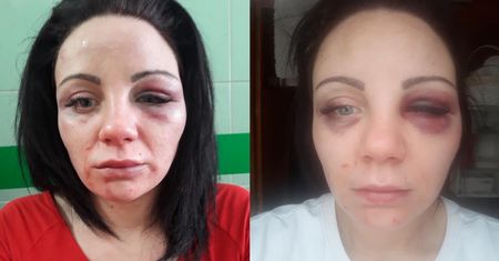 Martyna opublikowała zdjęcia pobitej twarzy. Jej historia jest wstrząsająca