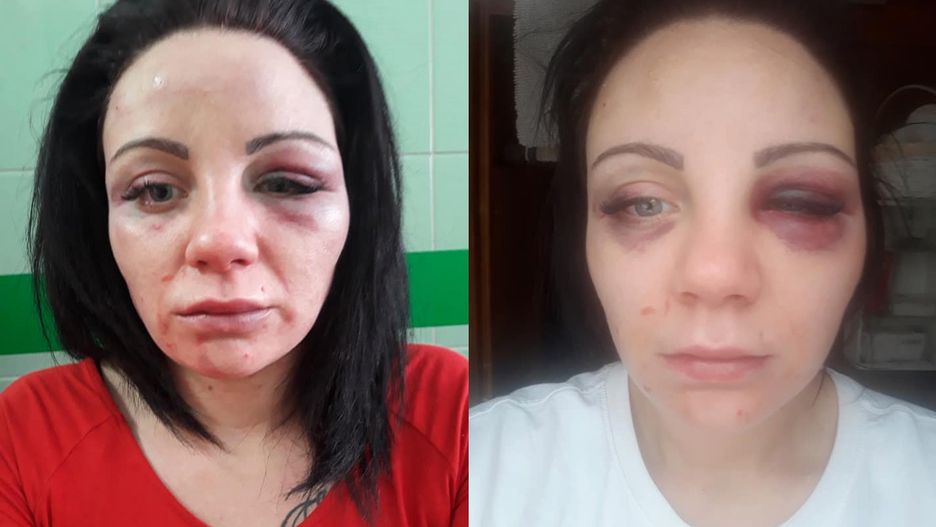 Kobieta opublikowała zdjęcia twarzy po pobiciu