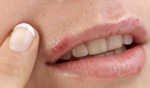 Naukowcy z Gdańska opracowali nowy preparat przeciwko objawom opryszczki