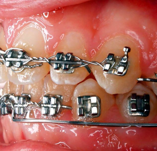 Aparat ortodontyczny założony na stałe 