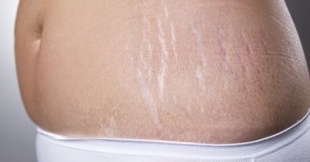 Zabiegi na rozstępy – czym jest dermabrazja?