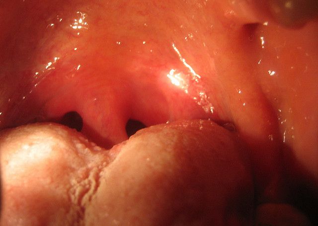 Zdjęcie obrazujące zmiany w jamie ustnej 