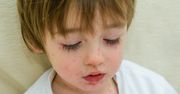 Myślała, że syn ma alergię. Szybka reakcja uratowała jego zdrowie