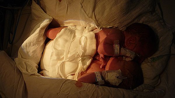 Zrośnięte brzuszkami bliźnięta syjamskie