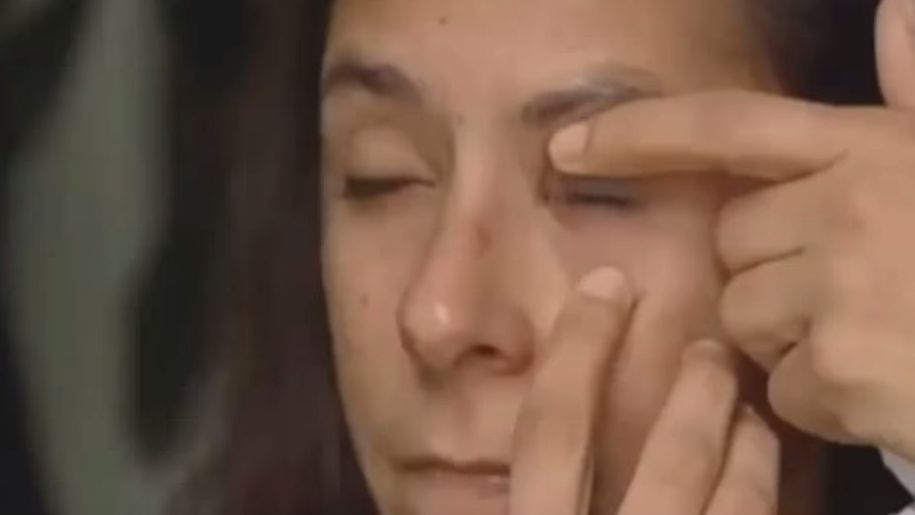 Skleił jej oko super glue