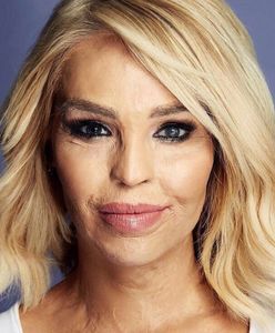 "Czułam, jak moja twarz pali się żywcem". Jak dziś wygląda oblana kwasem Katie Piper?