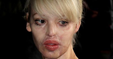 Katie Piper została zgwałcona, więziona i oblana kwasem. Błagała matkę, by ją zabiła