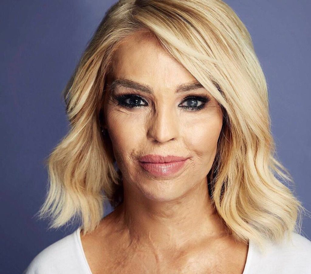 "Czułam, jak moja twarz pali się żywcem". Jak teraz wygląda oblana kwasem Katie Piper?