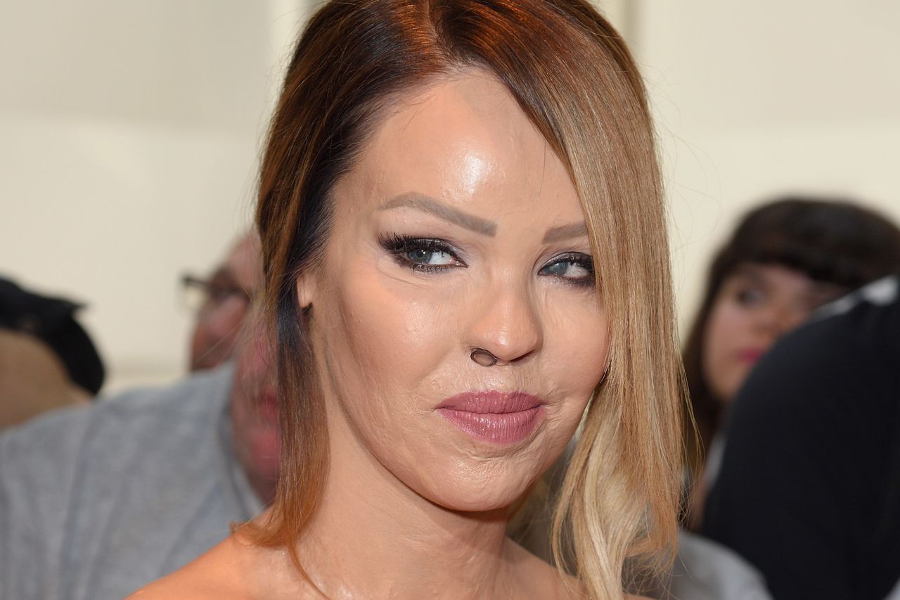 Katie Piper została oblana kwasem na zlecenie byłego partnera. Dziś apeluje do kobiet