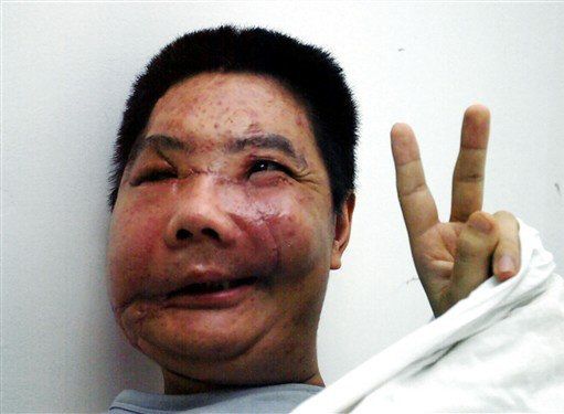 Zmarł Chińczyk, któremu przeszczepiono część twarzy