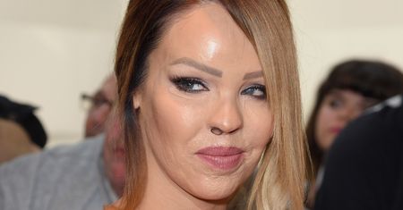 Katie Piper o problemie z okiem. To konsekwencja oblania kwasem