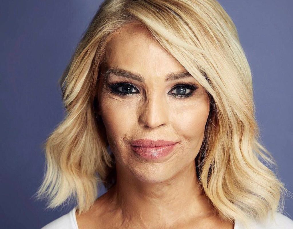 "Czułam, jak moja twarz pali się żywcem". Jak dziś wygląda oblana kwasem Katie Piper?