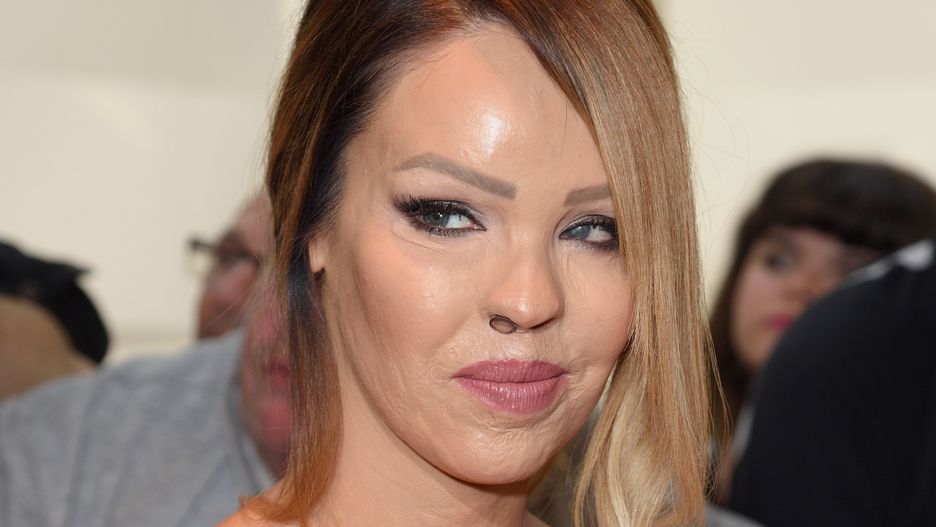 Katie Piper pokazała, co działo się z jej okiem