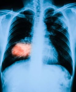 Chorzy na raka płuc pacjentami drugiej kategorii? "Jesteśmy rozczarowani"