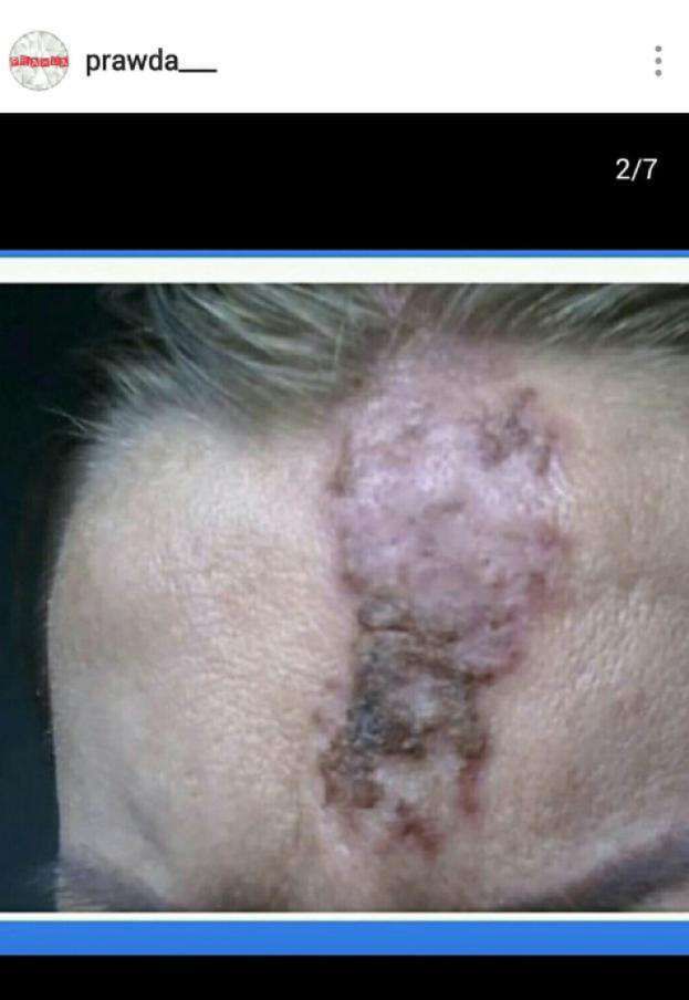 Pacjentka po zabiegu u Pauliny Pszech